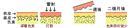 極光除斑→治療進程：深層的色素，則是被雷射打散，再慢慢由皮膚的淋巴組織吸收。一般需要至少1-2個月。色素如果有殘留，則還需要再幾次雷射治療。 